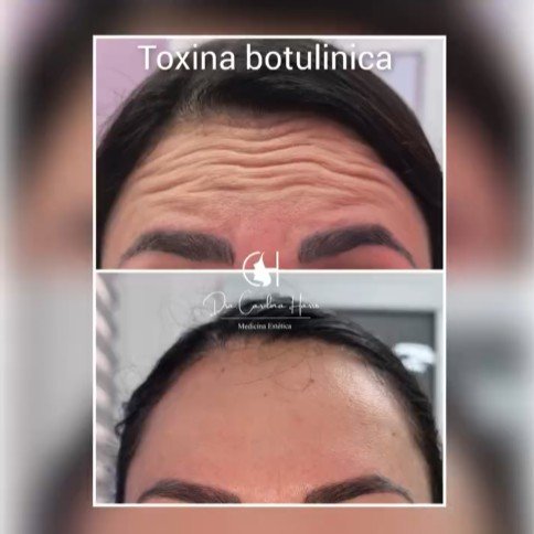Botox