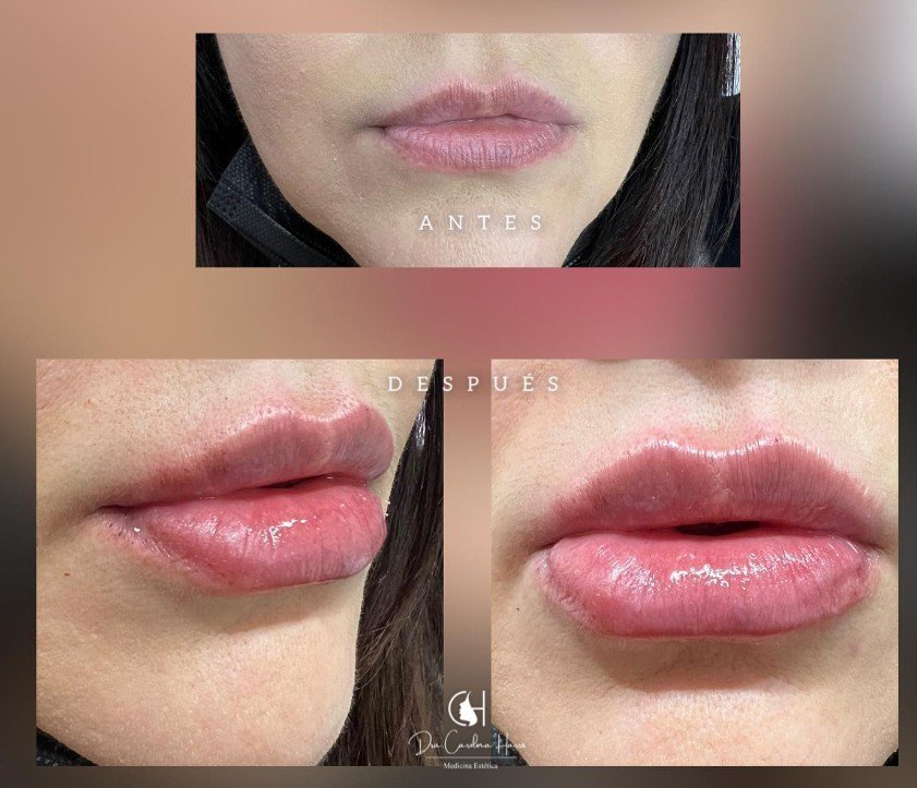 Relleno de labios